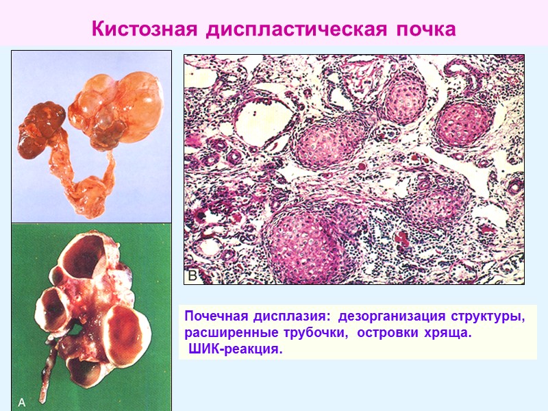 Кистозная диспластическая почка  Почечная дисплазия:  дезорганизация структуры,  расширенные трубочки,  островки